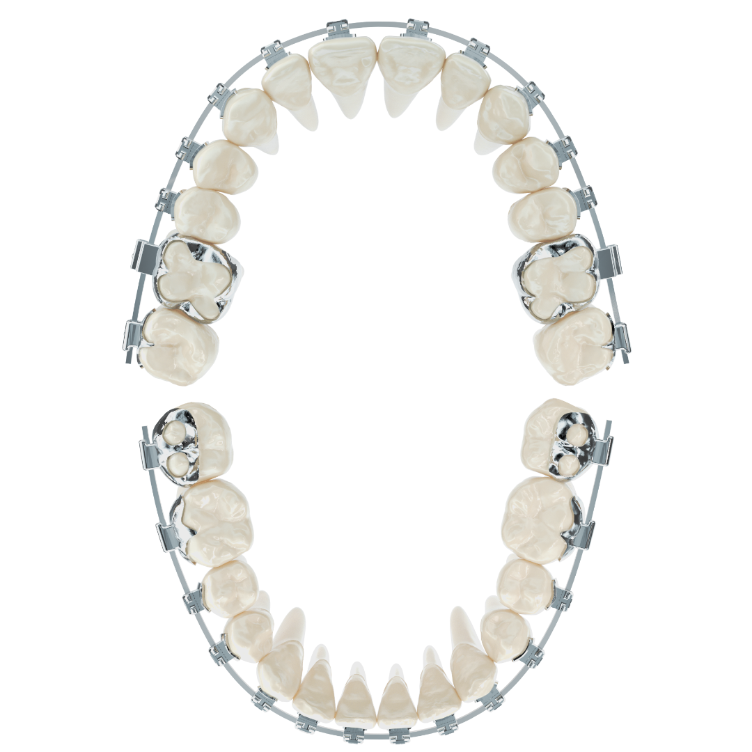 精功齿科 JG Digital Orthodontics-定制式正畸托槽-FORMULA S / U