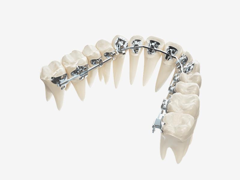 精功齿科 JG Digital Orthodontics-定制式正畸托槽-FORMULA